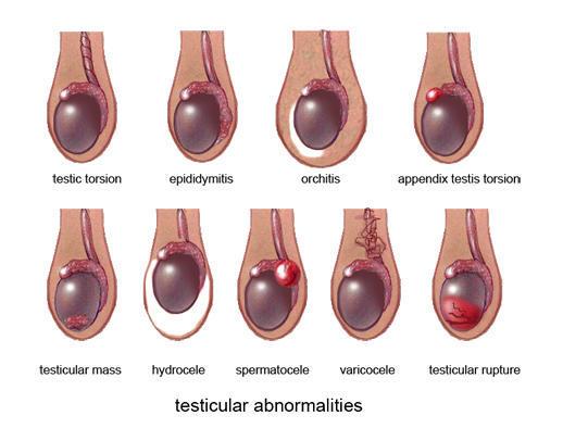 Testicular Cancer